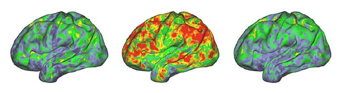 Psilocybin temporarily disrupts brain networks